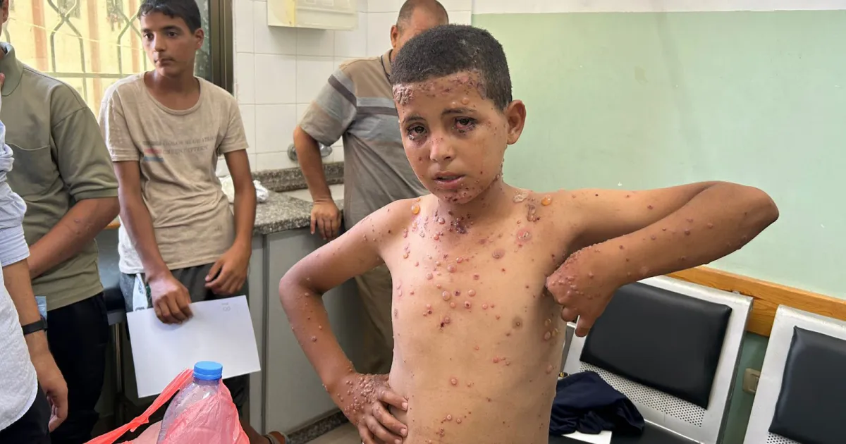 غزة تحت النار ... قوارض تقضم الاجساد وأوبئة وأمراض تنتشران بقوة بين السكان  