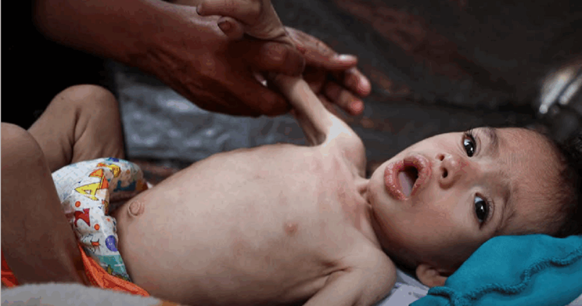 مصدر طبي : مرض الحمى الشوكية يفتك بأهالي غزة .. وخان يونس الأكثر تضررا 