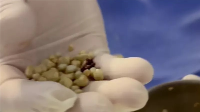 طبيب يستخرج 30 حصوة من كلية رجل والسبب 